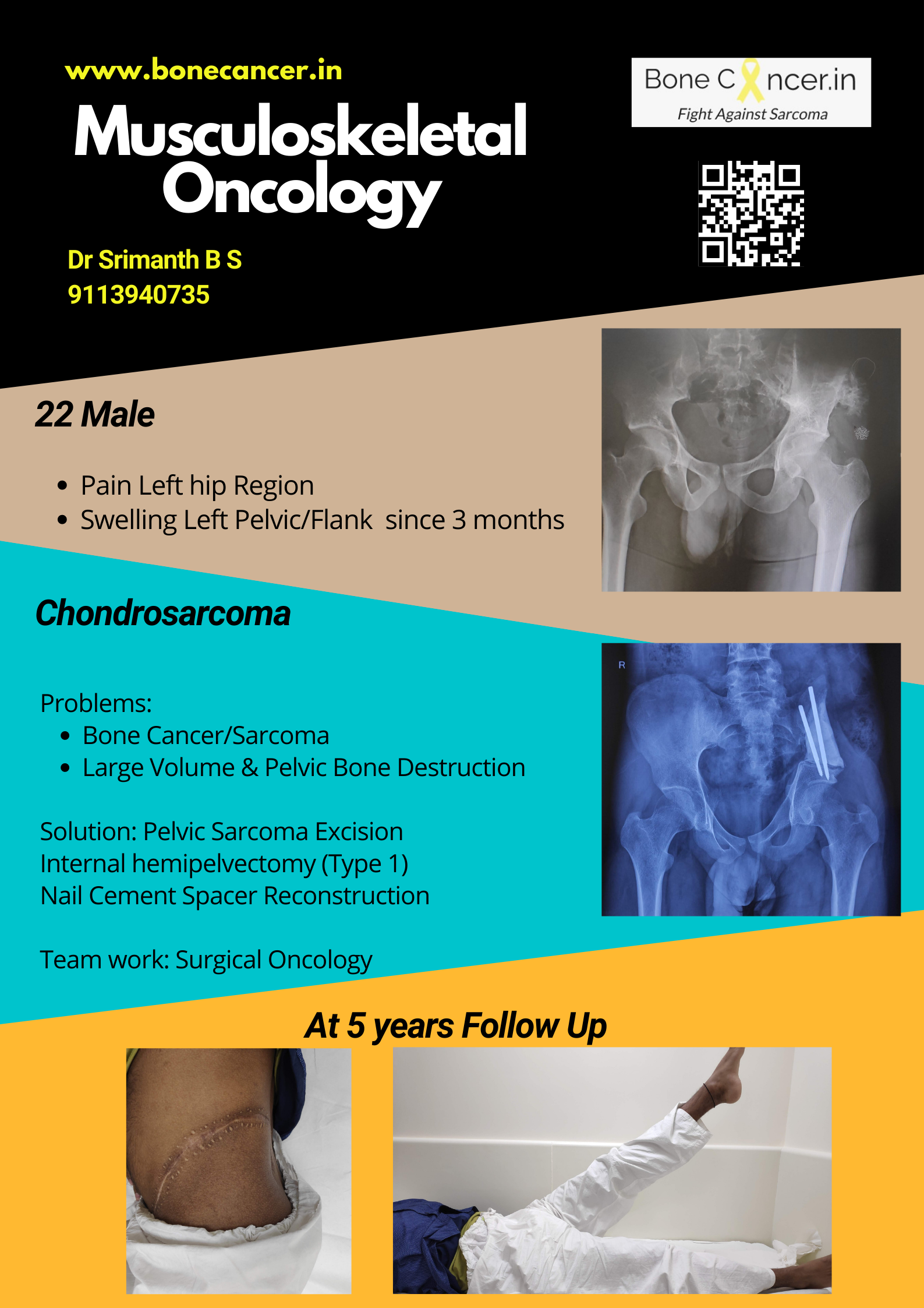 chondrosarcoma x ray