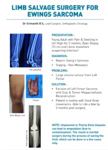 Ewing's sarcoma Limb salvage