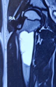 Simple Bone Cyst (SBC/UBC) MRI
