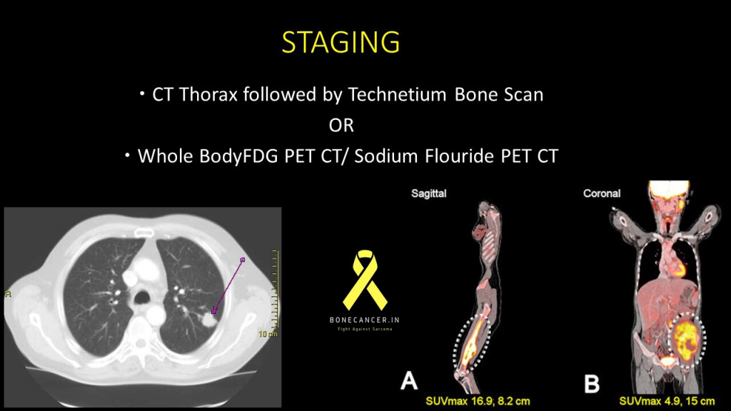 PET CT in Sarcomas