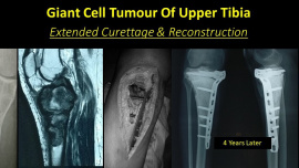 Giant Cell Tumour Tibia Extended Curettage Surgery
