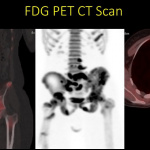 Pet CT sarcomas