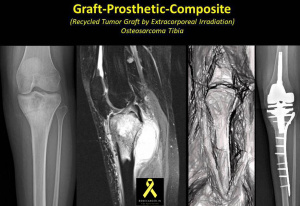 Irradiated Graft Prosthetic Composite